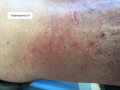 Eczémacraquelé9.png