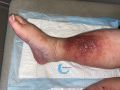 Hypodermite chronique74.jpg