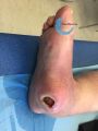 Pied de Charcot18.jpg