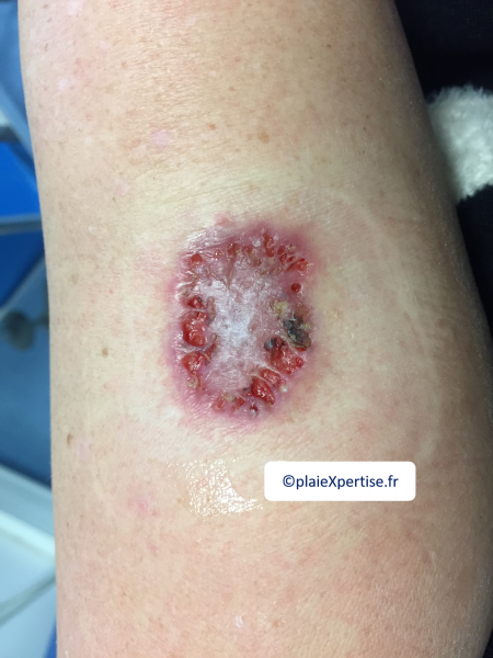 Fichier:Pyoderma gangrenosum13.png