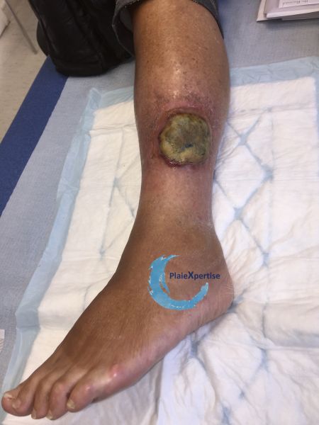 Fichier:Pyoderma gangrenosum28.jpg