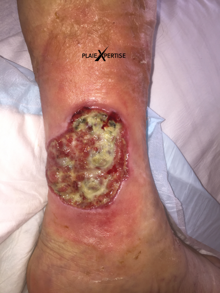 Fichier:Lymphome cutané ulcéré3.png