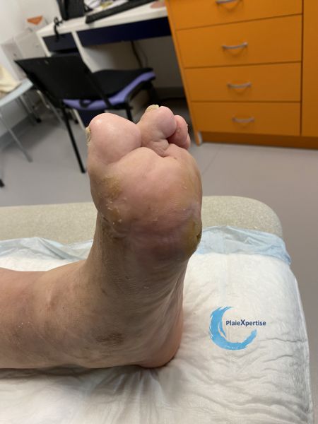 Fichier:Pied de Charcot41.jpg