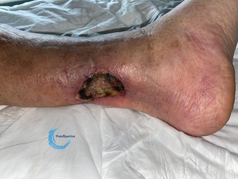 Fichier:Angiodermite typique113.jpg