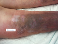 Dermatoporose14.png