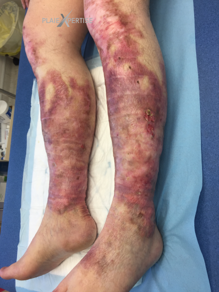 Fichier:Epidermolyse bulleuse acquise2.png
