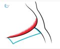 Intertrigo96.jpg