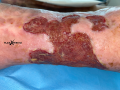 Tissu de granulation inflammatoire18.png