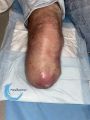 Amputation54.jpg