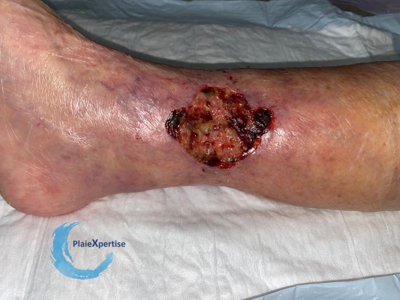 Fichier:Angiodermite typique77.jpg