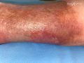 Dermiteocre42.png