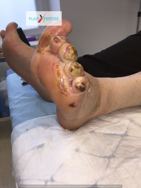 Fichier:Nécrose humide Pied 6.jpg