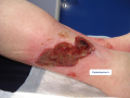 Tissu de granulation inflammatoire1.png