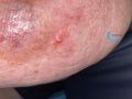 Pustules24.jpg