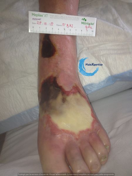 Fichier:Cou de pied103.jpg