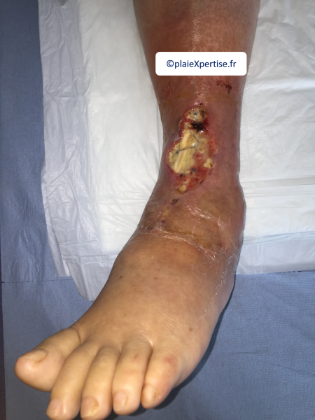 Fichier:Cou de pied25.png