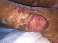 Lymphome cutané ulcéré10.png
