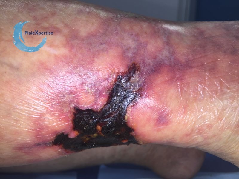 Fichier:Angiodermite typique71.jpg