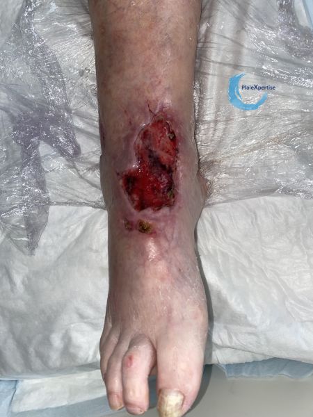 Fichier:Cou de pied94.jpg