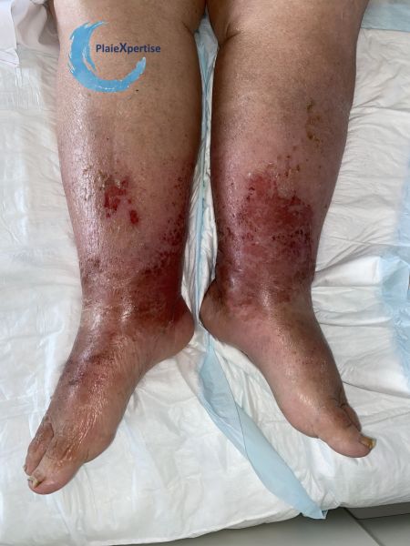 Fichier:Grosses jambes suintantes45.jpg