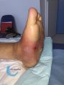 Pied de Charcot29.jpg
