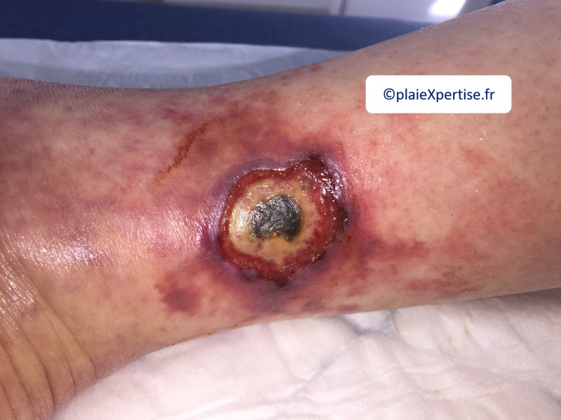 Fichier:Angiodermite typique21.png