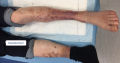 Nécrobiose lipoïdique7.png