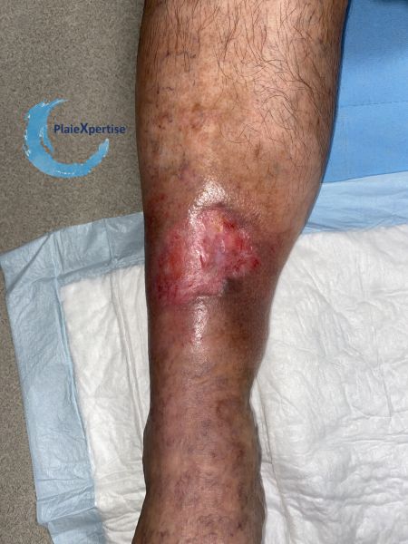 Fichier:Epidermisation17.jpg