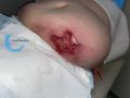 Calciphylaxie13.jpg