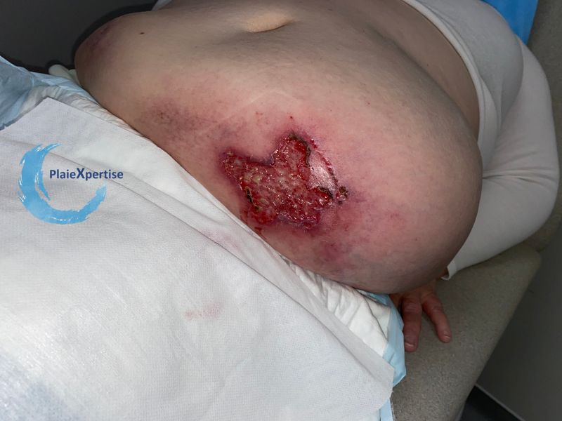 Fichier:Calciphylaxie13.jpg