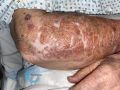 Dermatoporose53.jpg
