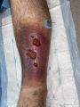 Hypodermite chronique54.jpg