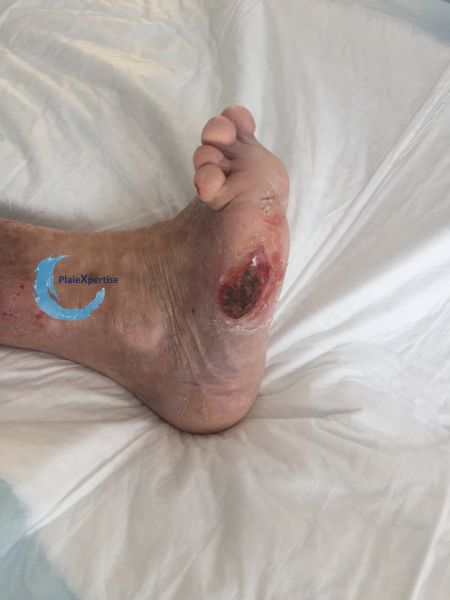 Fichier:Pied déformé1.jpg