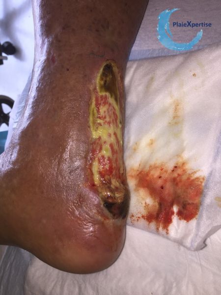 Fichier:Ulcère achiléen21.jpg