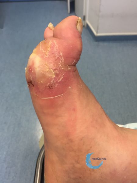 Fichier:Pied infecté13.jpg