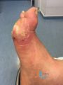 Pied infecté13.jpg