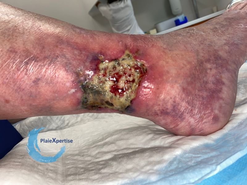 Fichier:Angiodermite typique89.jpg
