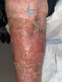 Dermite d'irritation129.jpg