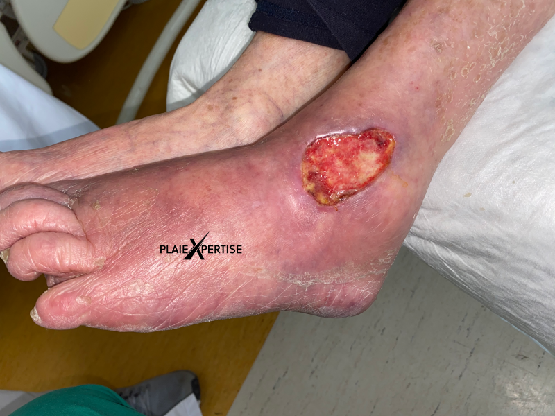 Fichier:Cou de pied46.png