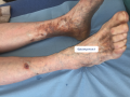 Dermiteocre6.png