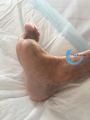 Pied de Charcot14.jpg