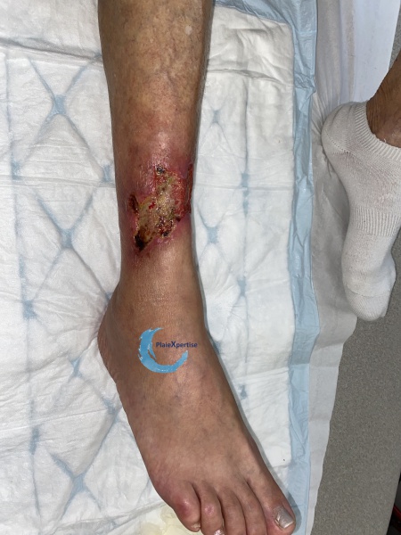Fichier:Angiodermite typique56.jpg