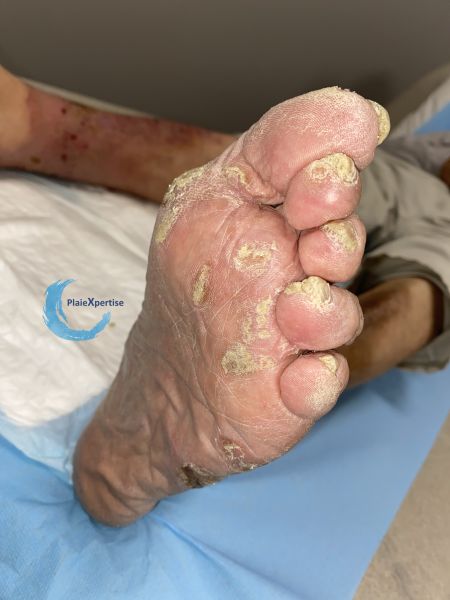 Fichier:Hyperkératose53.jpg