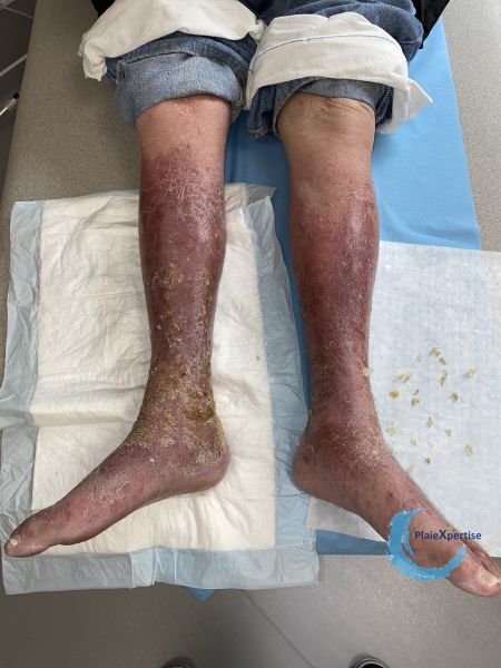 Fichier:Eczéma83.jpg