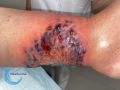 Pyoderma gangrenosum42.jpg