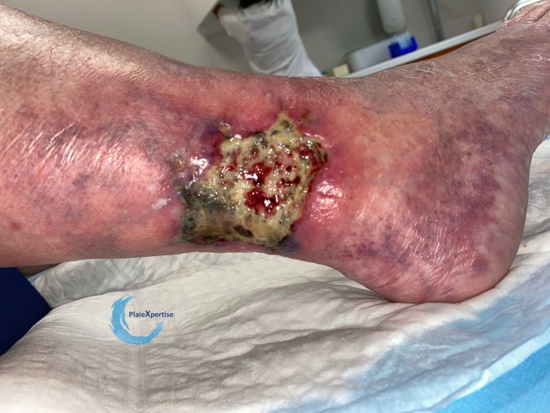 Fichier:Angiodermite typique104.jpg