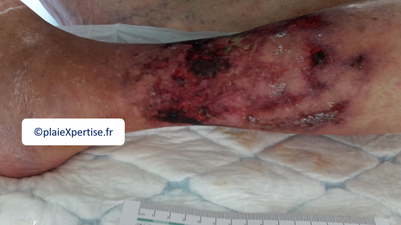 Fichier:Angiodermite typique30.png