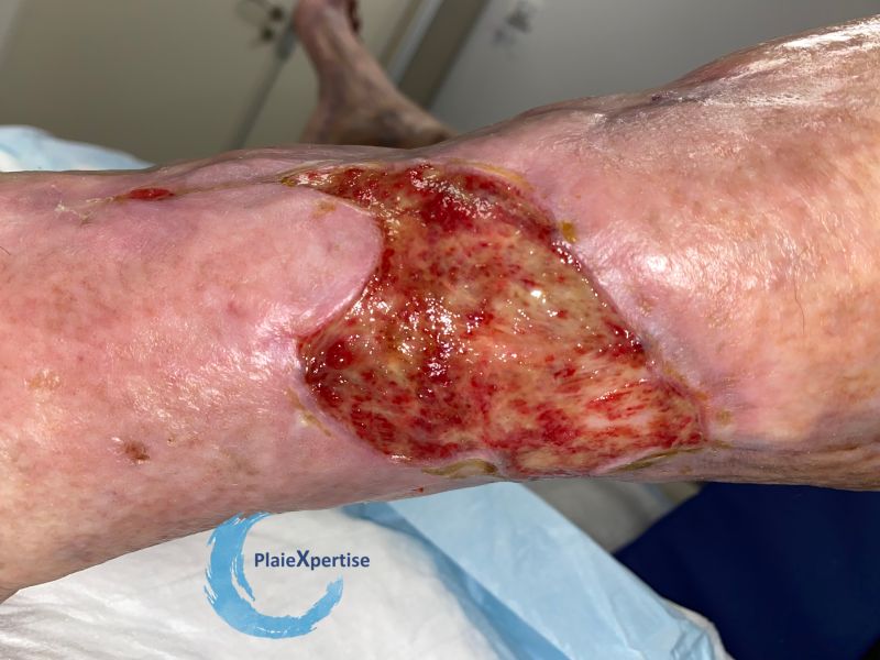 Fichier:Tissu de granulation inflammatoire38.jpg