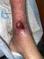 Angiodermite typique88.jpg