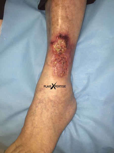 Fichier:Angiodermite typique40.png